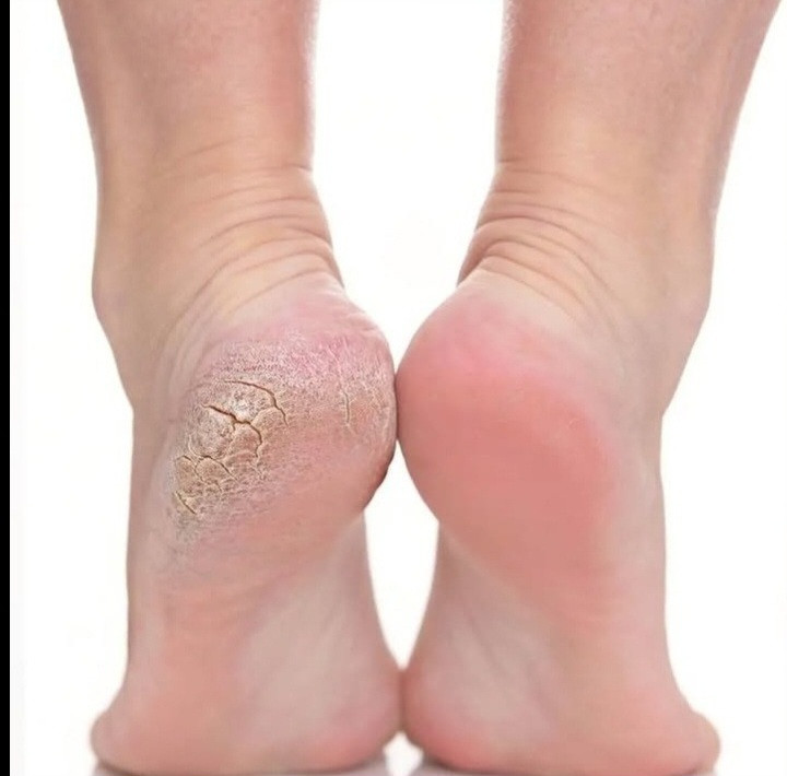 انتخاب با خودته پاهای سالم وزیبا یا ترک خورده وبد شکل😐