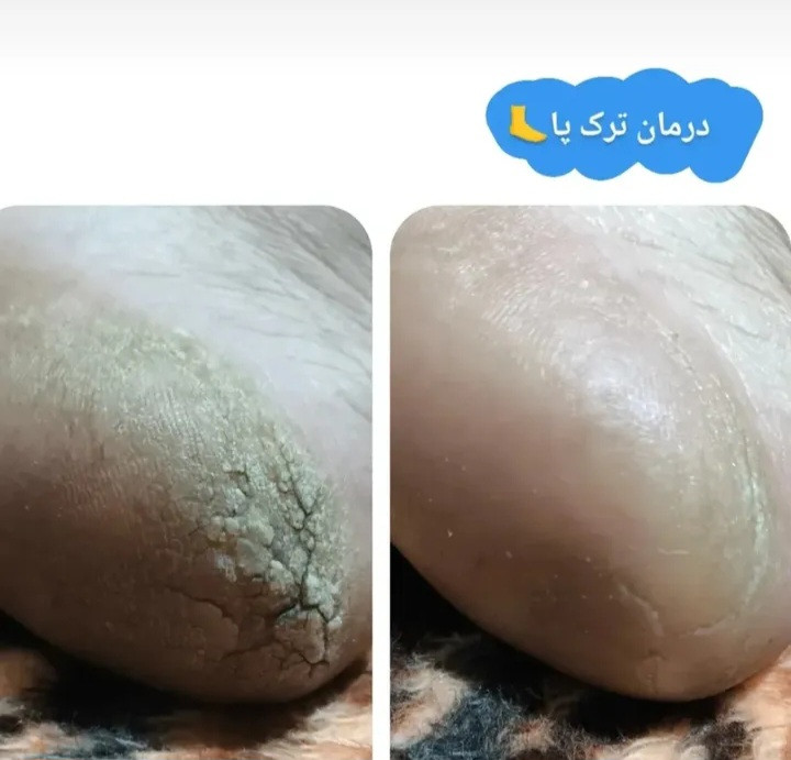 نتیجه استفاده از کرم ترک پا درکمترین زمان