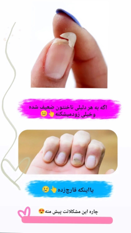 درمان تضمینی شکنندگی ناخن ها