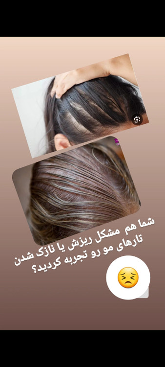 درمان ریزش و کم پشتی موها