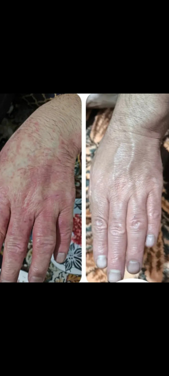 درمان خشکی واگزما پوست